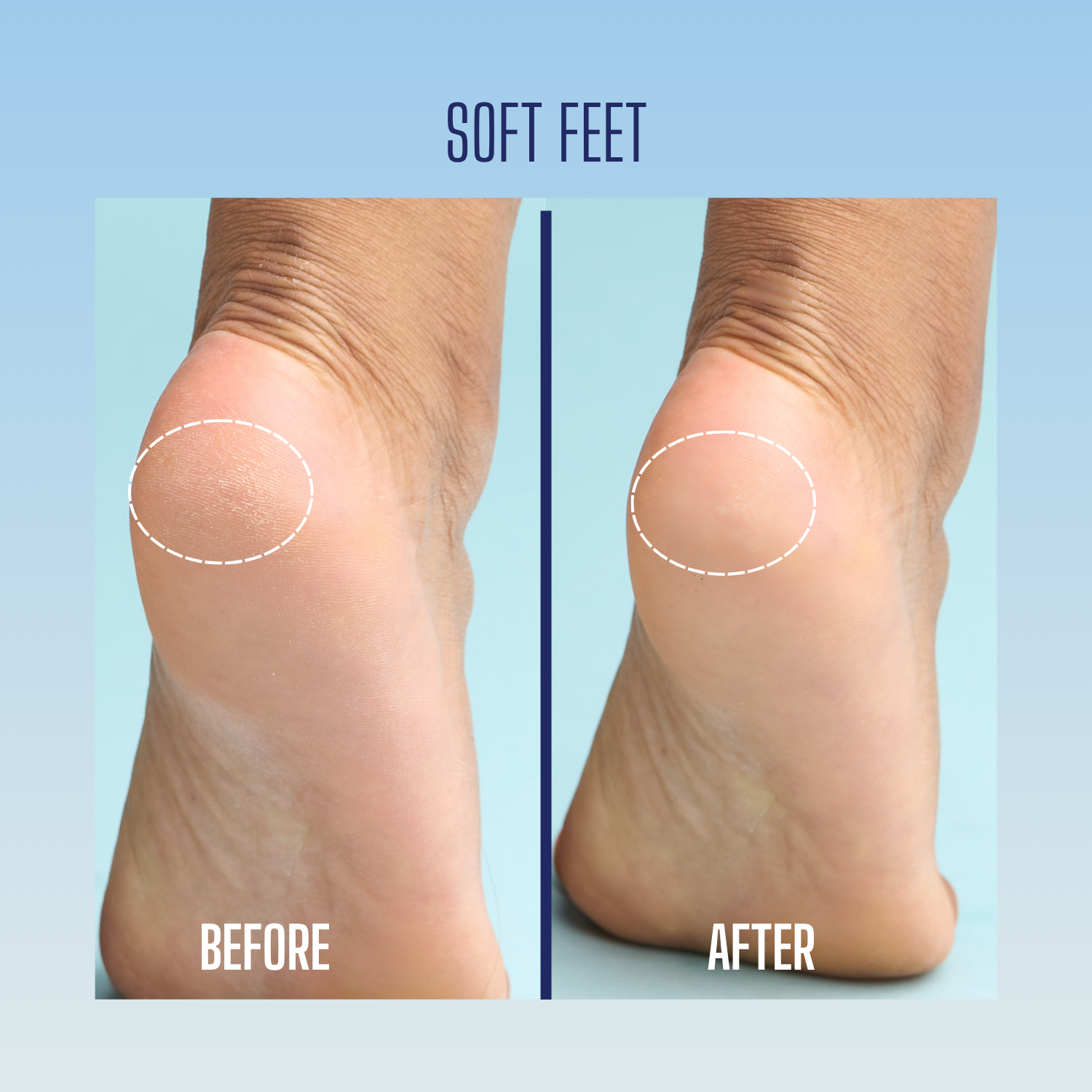 Soft Feet